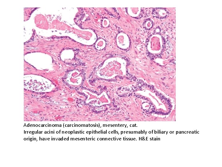 Adenocarcinoma (carcinomatosis), mesentery, cat. Irregular acini of neoplastic epithelial cells, presumably of biliary or