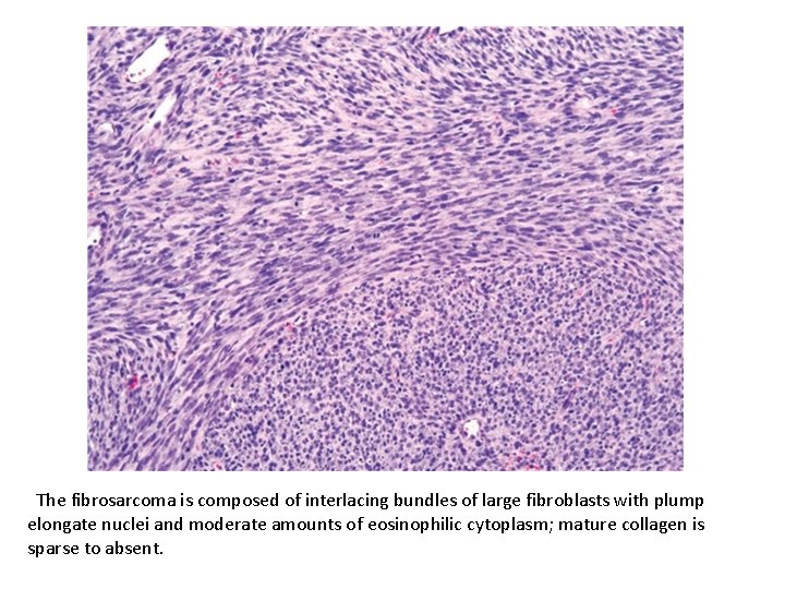 The fibrosarcoma is composed of interlacing bundles of large fibroblasts with plump elongate nuclei