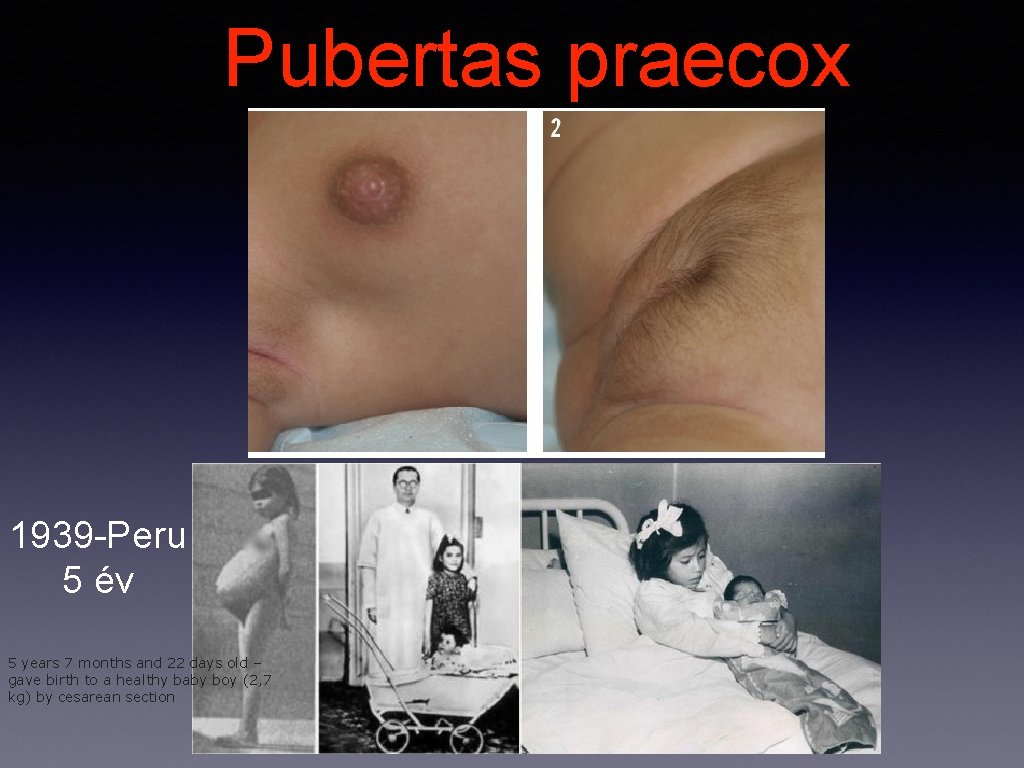 Pubertas praecox 1939 -Peru 5 év 5 years 7 months and 22 days old