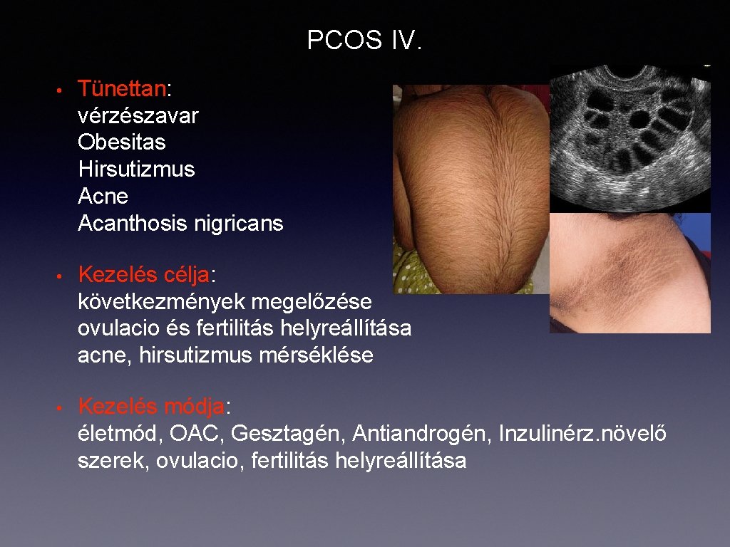 PCOS IV. • Tünettan: vérzészavar Obesitas Hirsutizmus Acne Acanthosis nigricans • Kezelés célja: következmények