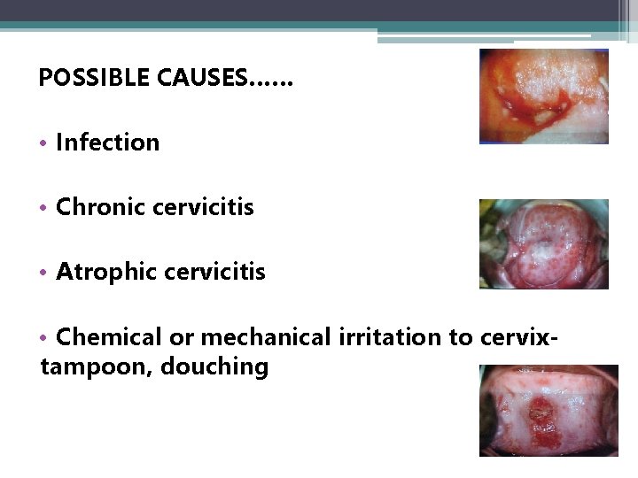 POSSIBLE CAUSES…… • Infection • Chronic cervicitis • Atrophic cervicitis • Chemical or mechanical