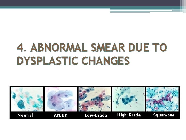 4. ABNORMAL SMEAR DUE TO DYSPLASTIC CHANGES 