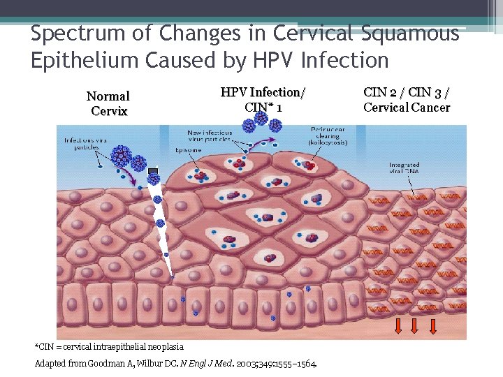 Spectrum of Changes in Cervical Squamous Epithelium Caused by HPV Infection Normal Cervix HPV