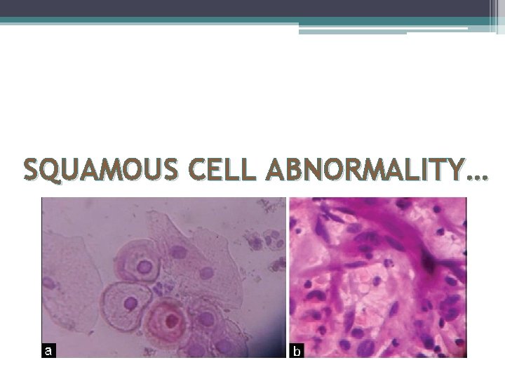 SQUAMOUS CELL ABNORMALITY… 