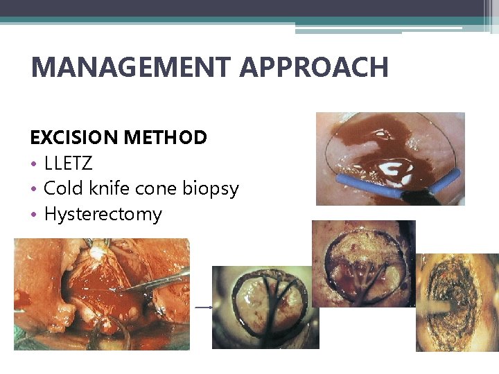 MANAGEMENT APPROACH EXCISION METHOD • LLETZ • Cold knife cone biopsy • Hysterectomy 