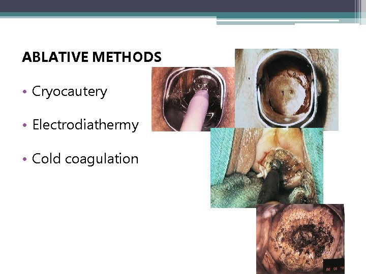 ABLATIVE METHODS • Cryocautery • Electrodiathermy • Cold coagulation 