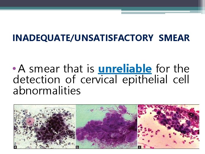 INADEQUATE/UNSATISFACTORY SMEAR • A smear that is unreliable for the detection of cervical epithelial