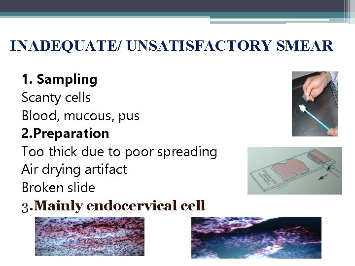 INADEQUATE/ UNSATISFACTORY SMEAR 1. Sampling Scanty cells Blood, mucous, pus 2. Preparation Too thick