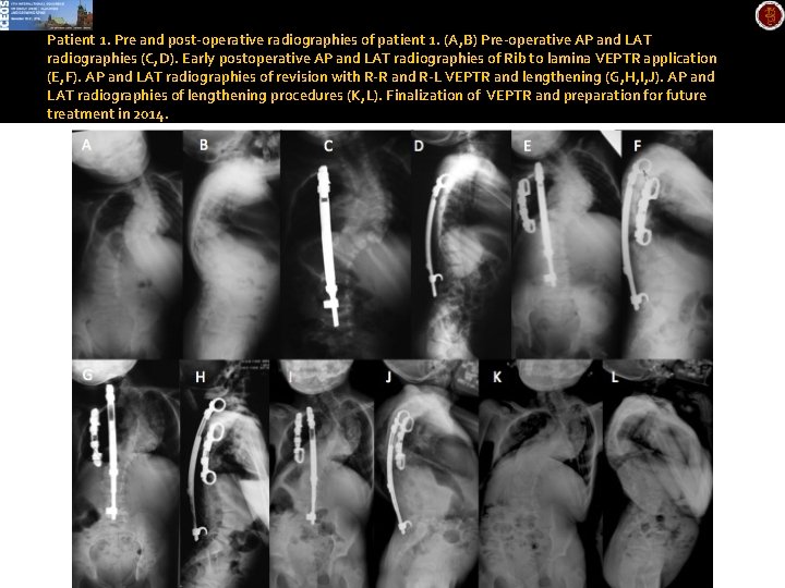 Patient 1. Pre and post-operative radiographies of patient 1. (A, B) Pre-operative AP and