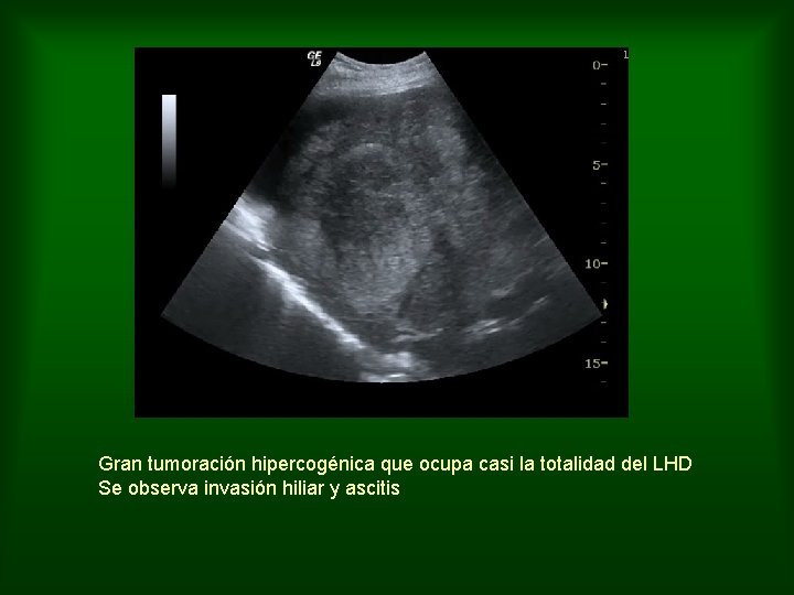 Gran tumoración hipercogénica que ocupa casi la totalidad del LHD Se observa invasión hiliar