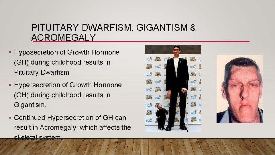 PITUITARY DWARFISM, GIGANTISM & ACROMEGALY • Hyposecretion of Growth Hormone (GH) during childhood results
