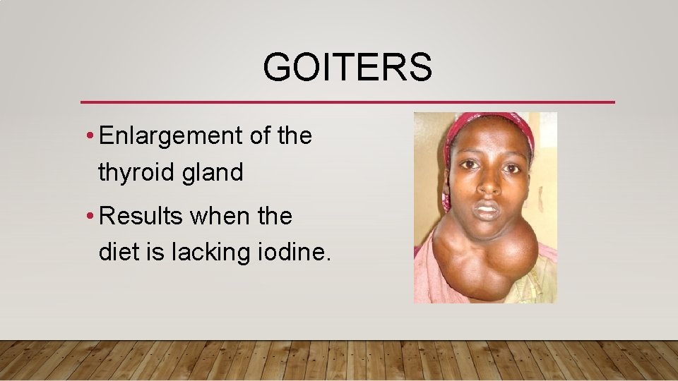 GOITERS • Enlargement of the thyroid gland • Results when the diet is lacking
