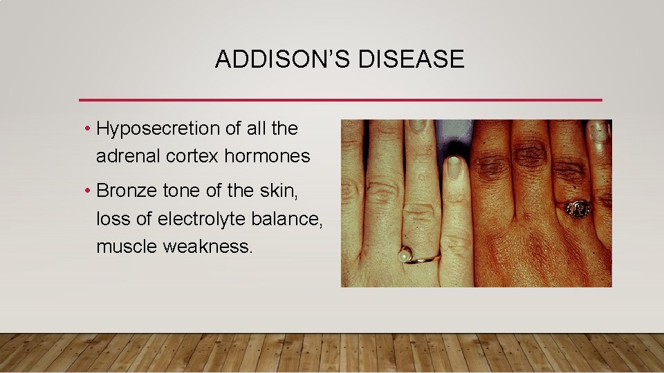ADDISON’S DISEASE • Hyposecretion of all the adrenal cortex hormones • Bronze tone of