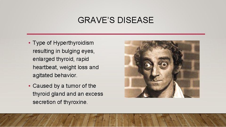 GRAVE’S DISEASE • Type of Hyperthyroidism resulting in bulging eyes, enlarged thyroid, rapid heartbeat,