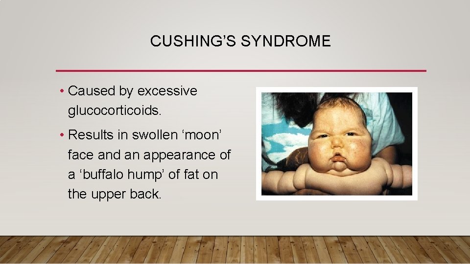 CUSHING’S SYNDROME • Caused by excessive glucocorticoids. • Results in swollen ‘moon’ face and