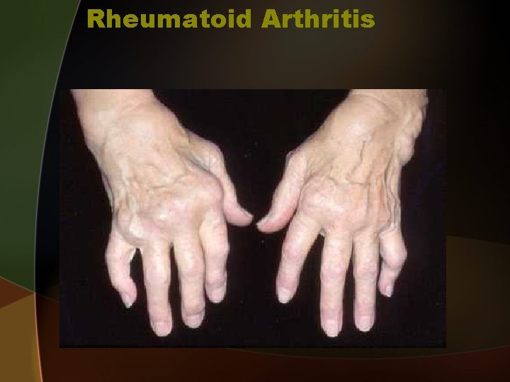 Rheumatoid Arthritis 