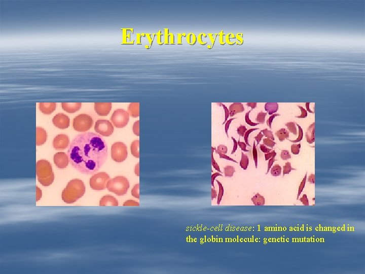 Erythrocytes sickle-cell disease: 1 amino acid is changed in the globin molecule: genetic mutation