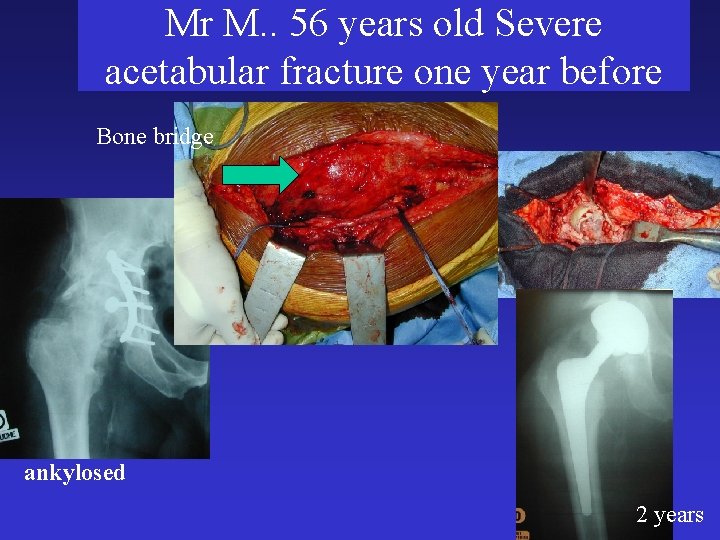Mr M. . 56 years old Severe acetabular fracture one year before Bone bridge