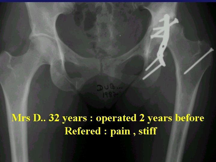 Mrs D. . 32 years : operated 2 years before Refered : pain ,