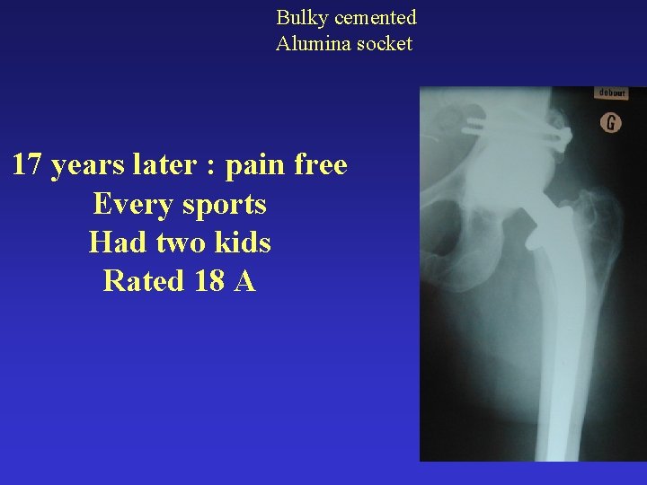 Bulky cemented Alumina socket 17 years later : pain free Every sports Had two