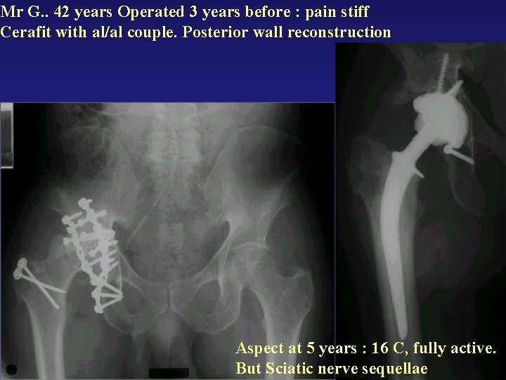 Mr G. . 42 years Operated 3 years before : pain stiff Cerafit with