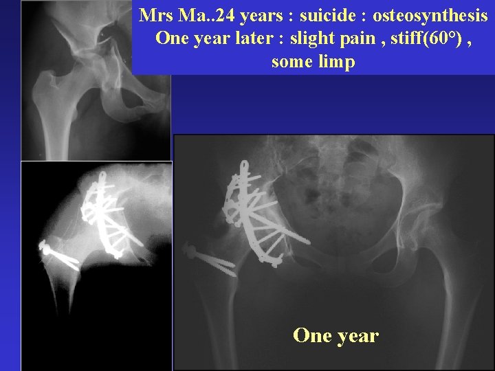 Mrs Ma. . 24 years : suicide : osteosynthesis One year later : slight