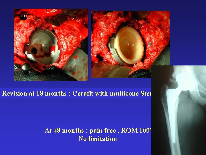 Revision at 18 months : Cerafit with multicone Stem At 48 months : pain