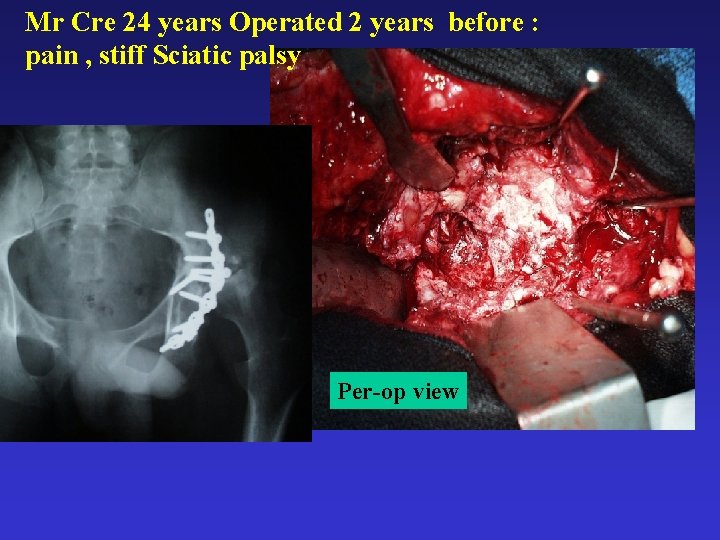 Mr Cre 24 years Operated 2 years before : pain , stiff Sciatic palsy