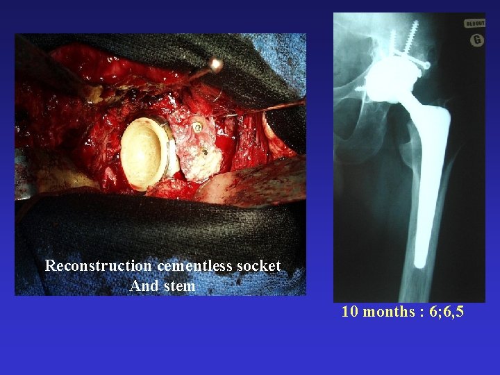 Reconstruction cementless socket And stem 10 months : 6; 6, 5 