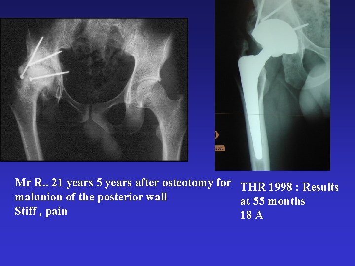Mr R. . 21 years 5 years after osteotomy for THR 1998 : Results