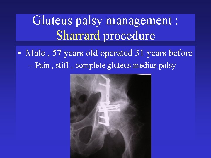 Gluteus palsy management : Sharrard procedure • Male , 57 years old operated 31