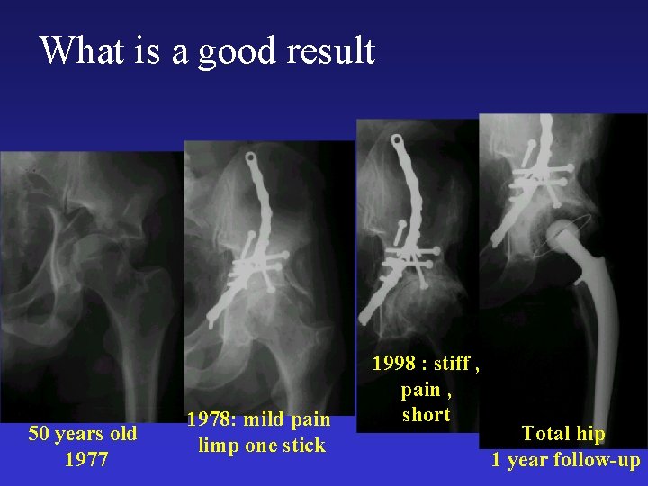 What is a good result 50 years old 1977 1978: mild pain limp one