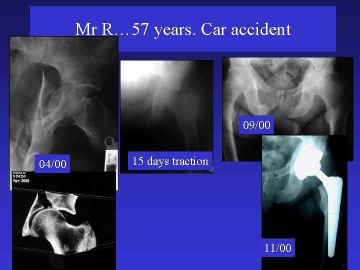 Mr R… 57 years. Car accident 09/00 04/00 15 days traction 11/00 