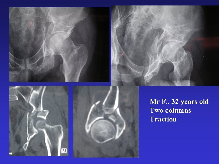 Mr F. . 32 years old Two columns Traction 