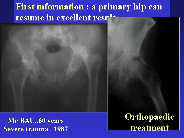 First information : a primary hip can resume in excellent result Mr BAU. .