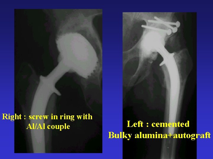 Right : screw in ring with Al/Al couple Left : cemented Bulky alumina+autograft 