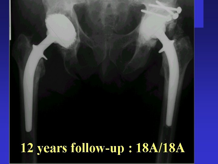 12 years follow-up : 18 A/18 A 