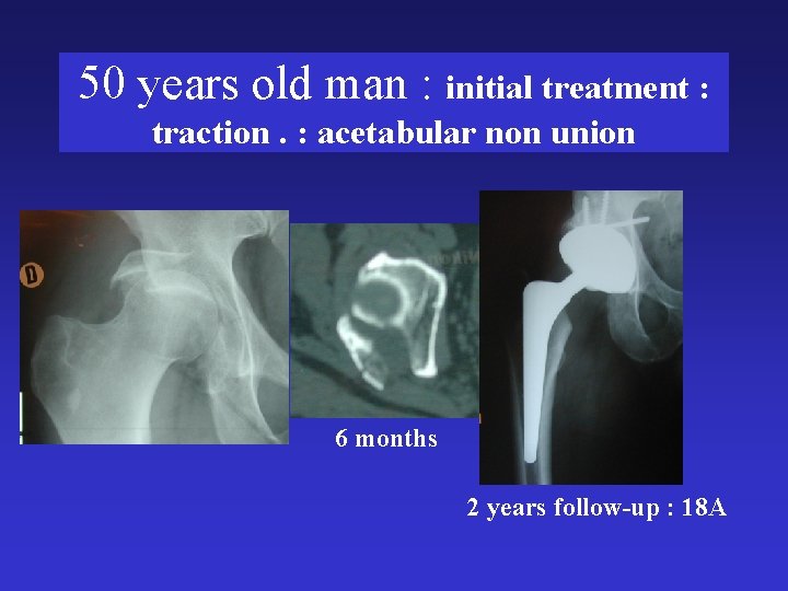 50 years old man : initial treatment : traction. : acetabular non union 6