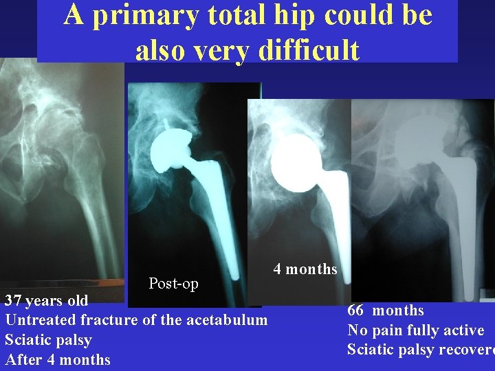 A primary total hip could be also very difficult Post-op 37 years old Untreated