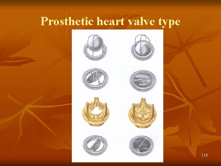 Prosthetic heart valve type 116 