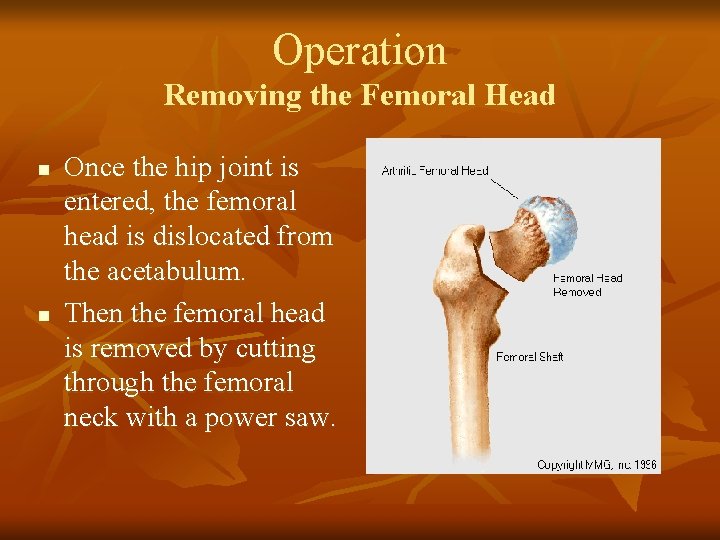 Operation Removing the Femoral Head n n Once the hip joint is entered, the