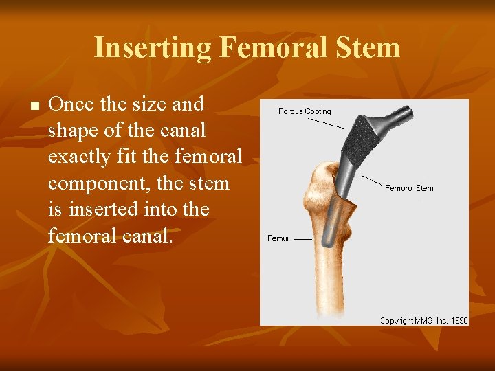 Inserting Femoral Stem n Once the size and shape of the canal exactly fit