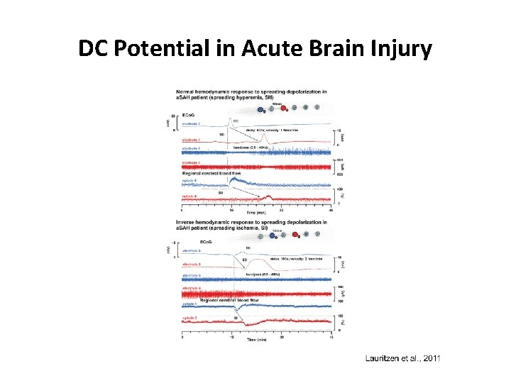 DC Potential in Acute Brain Injury 