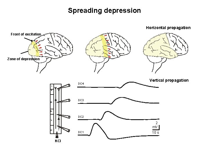Spreading depression Horizontal propagation Front of excitation Zone of depression DC 4 I Vertical