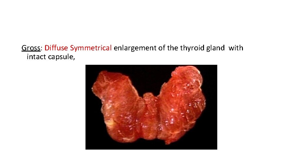 Gross: Diffuse Symmetrical enlargement of the thyroid gland with intact capsule, 