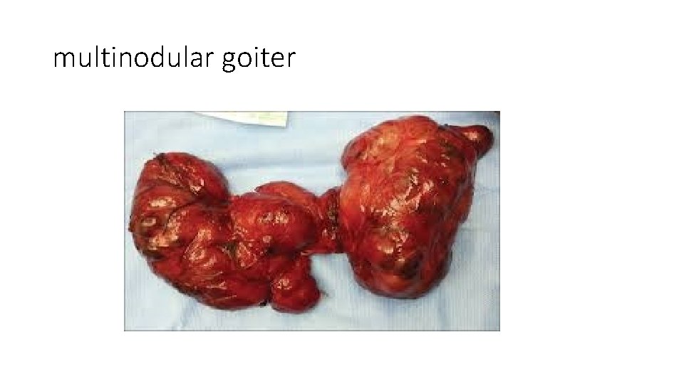 multinodular goiter 