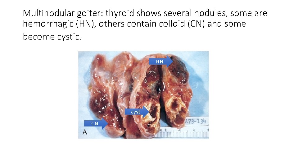Multinodular goiter: thyroid shows several nodules, some are hemorrhagic (HN), others contain colloid (CN)