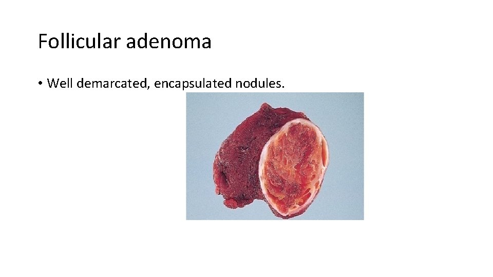 Follicular adenoma • Well demarcated, encapsulated nodules. 