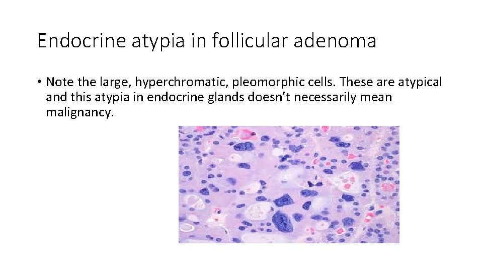 Endocrine atypia in follicular adenoma • Note the large, hyperchromatic, pleomorphic cells. These are