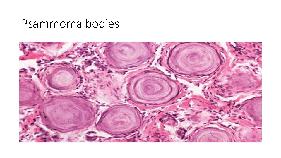 Psammoma bodies 